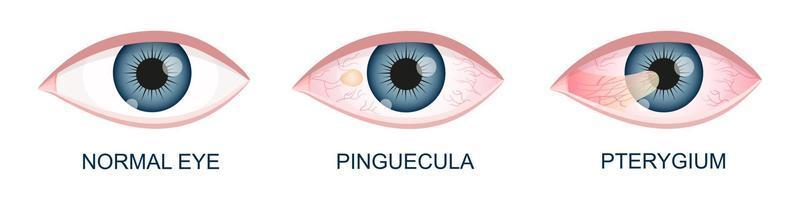 oog gezond, met pinguïn en pterygium groeit op hoornvlies. conjunctivaal degeneratie. oog ziekte. menselijk orgaan van visie met pathologie vector