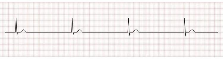 ekg toezicht houden op tonen junctionele bradycardie vector