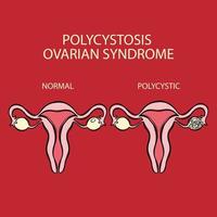 polycystisch eierstok syndroom vs normaal voortplantings- systeem vector