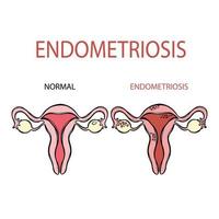 endometriose normaal vrouw voortplantings- systeem onderwijs vector