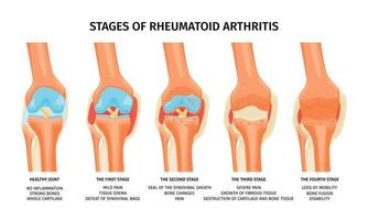 reumatoïde artritis stadia infographics vector