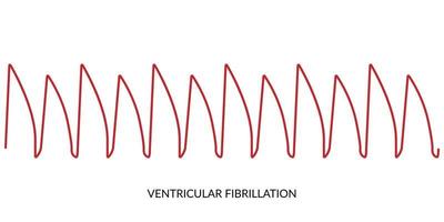 ecg hartslag lijn. elektrocardiogram vector illustratie. ventriculaire fibrillatie