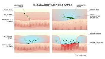 helicobacter pylori infectie werkwijze in menselijk maag met gastritis vector