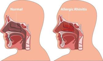 gezond nasaal passage vs rhinitis allergieën vector