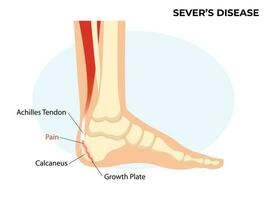scheiden ziekte, hielbeen apofysitis. enkel letsel gebroken bot vector