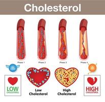 cholesterol in slagader en gezondheidsrisico vector