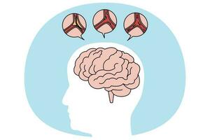 medisch illustratie van menselijk hersenen beroerte vector