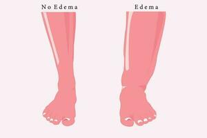 vergelijking van normaal voet en oedeem voet, vlak illustratie voor onderwijs. eps 10 vector