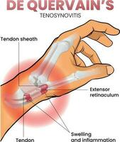 illustratie van de quervain syndroom of tenosynovitis vector