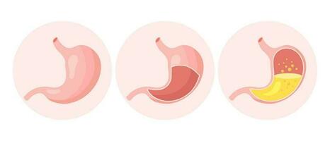 ongezond menselijk maag, medisch pictogrammen set. gastritis, zweer, maag pijn, opgeblazen gevoel. anatomie van de spijsvertering systeem. vector