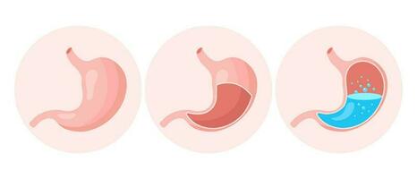 gezond leeg en vol menselijk maag, medisch pictogrammen set. gastritis, zweer, buik pijn, opgeblazen gevoel. anatomie van de spijsvertering systeem. vector