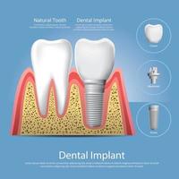 menselijke tanden en tandheelkundige implantaten vectorillustratie vector