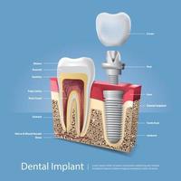 menselijke tanden en tandheelkundige implantaten vectorillustratie vector