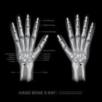 hand bot x-ray vectorillustratie vector