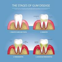 menselijke tanden stadia van tandvleesziekte vectorillustratie vector