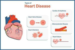 vector illustratie concept voor geneeskunde type van hart ziekte, atherosclerotisch ziekte, hart hartritmestoornissen, hart klep ziekte, hart infecties, hart falen.plat stijl