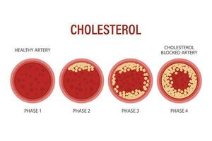 vasculair atherosclerose. stadia van atherosclerose cholesterol in slagaders, schepen. geneesmiddel, wetenschap, gezondheidszorg. infographic banier vector