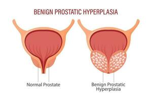 goedaardig prostaat hyperplasie. anatomie van menselijk organen. geneesmiddel, gezondheidszorg en wetenschap concept. onderwijs infographics banier vector