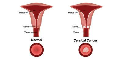 illustratie van cervicaal kanker vector