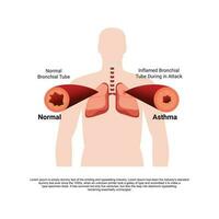 een astma-ontstoken bronchiale buis vector