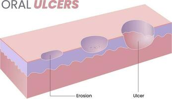 illustratie van mondeling zweer diagram vector