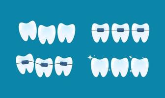 uitlijning van tanden en beetcorrectie met behulp van beugelsysteem vector