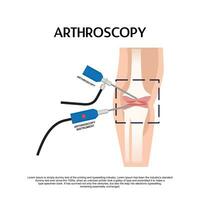 artroscopie medisch behandeling chirurgie sleutelgat chirurgisch traktatie endoscoop vector