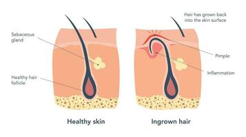 ingegroeide haar- en normaal haar- medisch schema's onder microscoop. ingegroeide haar- Leidt naar de roodheid en ontsteking, dat geassocieerd ook met puistjes en geblokkeerd poriën. vector illustratie
