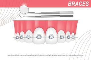 3d vector illustratie, realistisch tanden met een beugel bovenste en lager kaak. uitlijning van de beet van tanden, gebit met een beugel, tandheelkundig een beugel