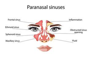 sinusitis, vrouw gezicht met ontsteking van de slijm- membraan van de paranasaal en frontaal sinussen. vector illustratie voor medisch posters en leerzaam materialen