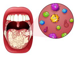 Een infectie met het menselijke mondvirus vector