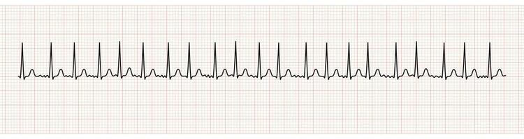 ekg toezicht houden op tonen atriaal fibrillatie met snel ventriculaire reactie vector