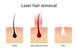 laser haar- verwijdering concept met huid en haar- gebieden. stadia van de verwijdering procedure. medisch diagram voordat en na gebruik makend van een laser. vector illustratie