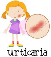 Een meisje met urticaria op de huid vector