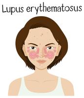 Een vector van Lupus Erythematosus