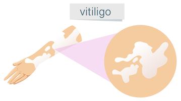 Een vector van Vitiligo op de huid