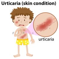 Een jonge man met urticaria vector