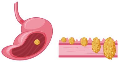 Kanker in de menselijke maag vector