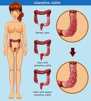 Menselijke anatomie van colitis ulcerosa vector