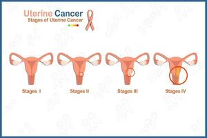 vlak medisch vector illustratie concept van 4 stadia van baarmoeder kanker Aan wit achtergrond.