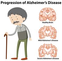 Voortgang van de ziekte van Alzheimer vector