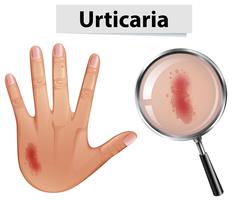 Urticaria vergroot bij de hand vector