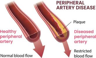 illustratie van perifeer slagader ziekte infographic vector