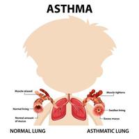 bronchiaal astma diagram met normale long en astmatische long vector