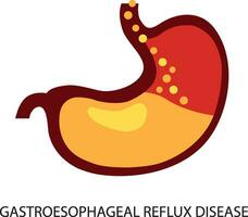 gastro-oesofageale reflux ziekte. maag gerd maagzuur slokdarm medisch illustratie. vector