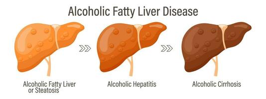 types van vettig lever. menselijk lever ziekten. alcoholisch vettig lever ziekte. hepatitis, lever cirrose, fibrose, steatose. medisch infographic spandoek. vector