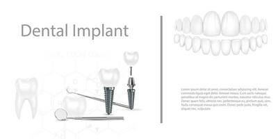 tandheelkundig implantaat structuur medisch schilderachtig educatief infographic poster met kies vervanging einde gezond gereedschap modellen vector illustratie.