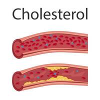 atherosclerose concept. vergroot slagader met plaquettes. medisch vector illustratie