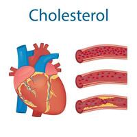 atherosclerose concept, Gezondheid risico. menselijk hart. medisch vector illustratie