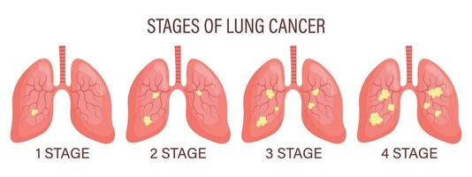 stadia van long kanker, long ziekte. medisch infographic banier, illustratie, vector